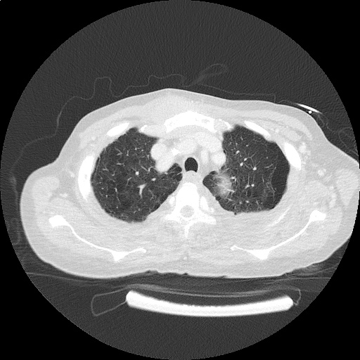 ct_chest_anemia_02